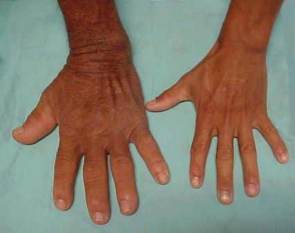 Acromegaly Symptoms what are the signs and symptoms