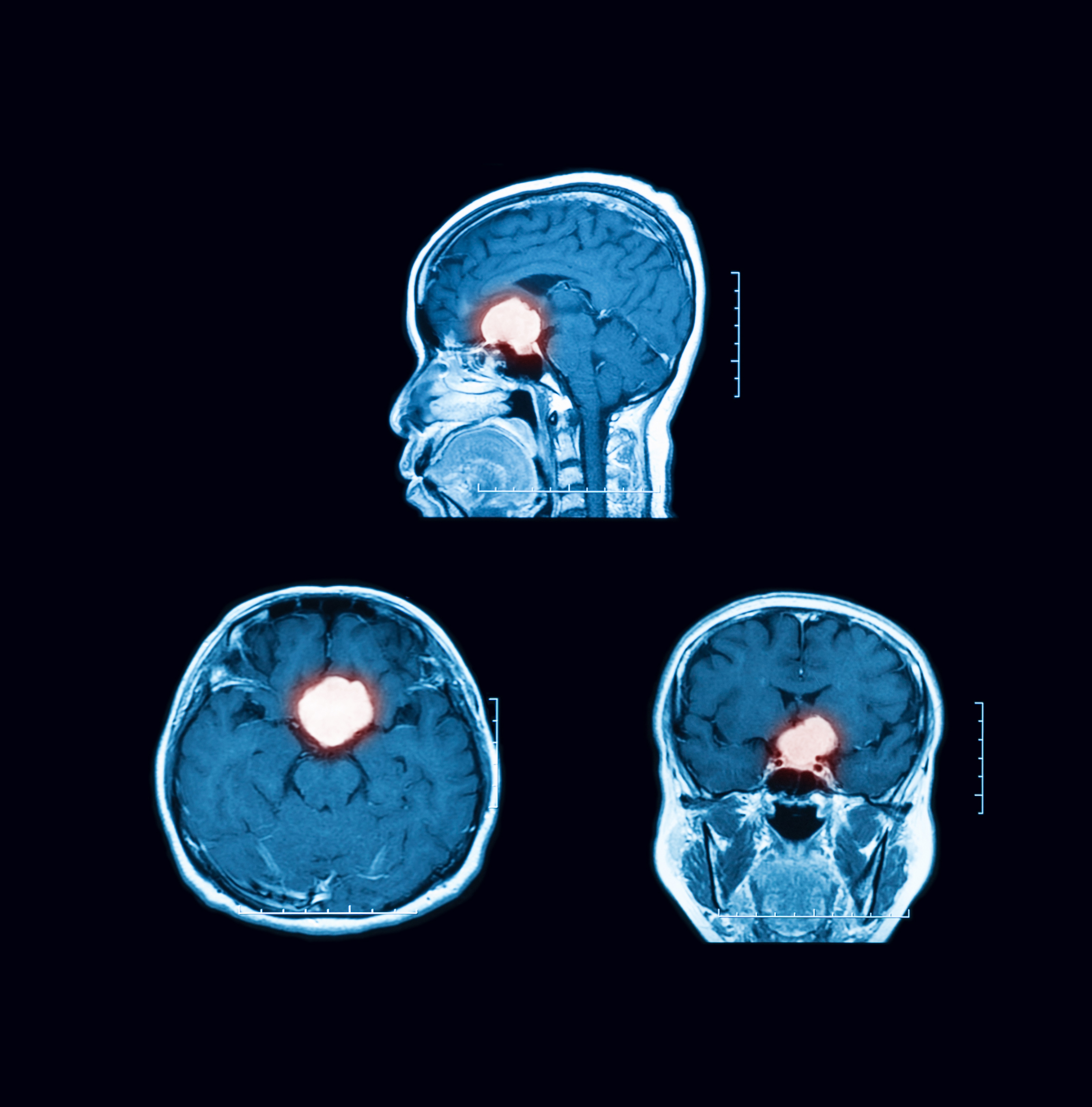 MRI Pituitary Gland